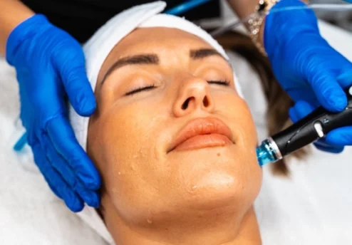 Microneedling